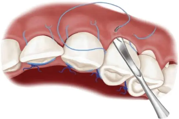 کاربردهای نخ بخیه در دندانپزشکی