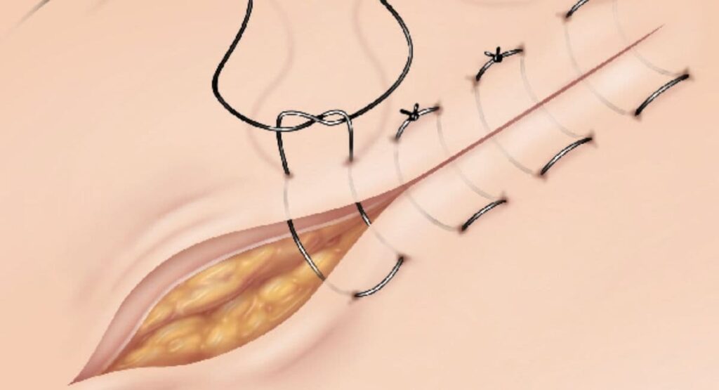 ویژگی‌های نخ بخیه غیر جذبی